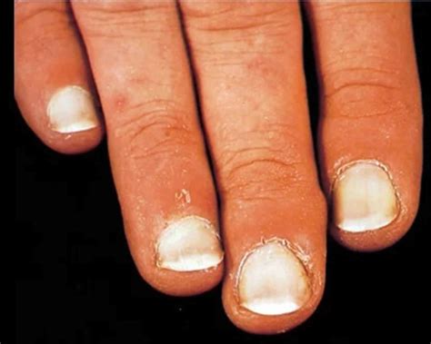 leukonychia definition|what is leukonychia.